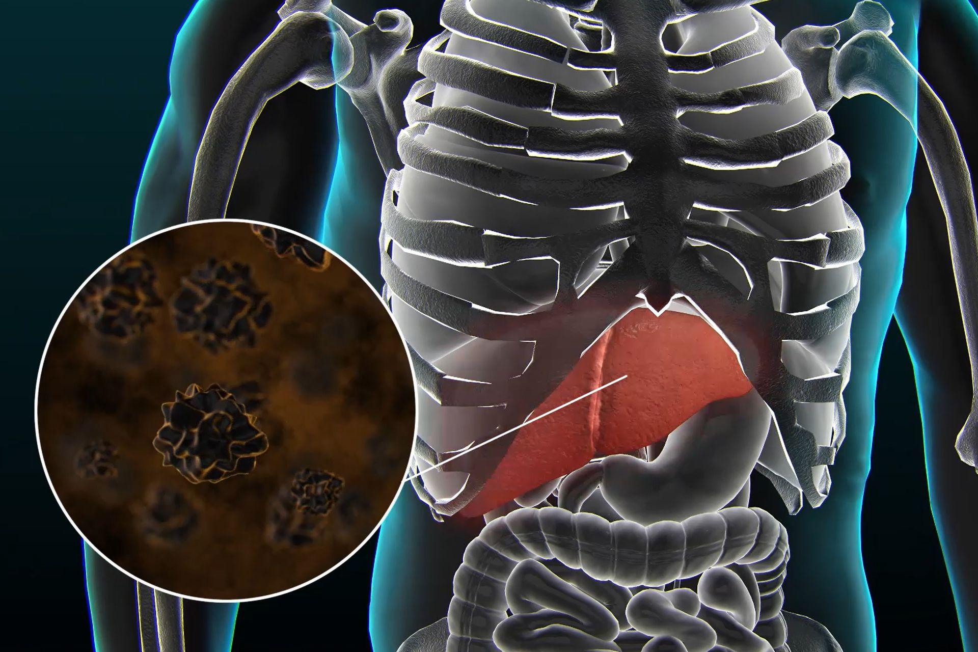 Recreación de piedras en la vesícula. Codigo2 Studios